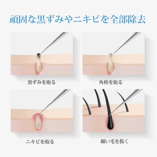 【0.1mm超微細先端、1秒で深層の黒ずみを除去】東京美容院同款プロ用黒ずみ・にきびピンセット✨毛穴の詰まりを取り除き、白く透き通った肌を手に入れましょう